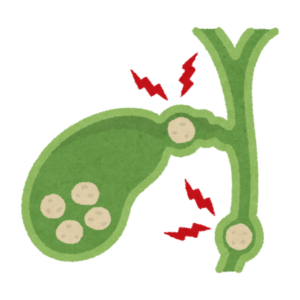 Bile Duct cancer